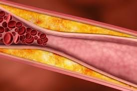 gordura acumulada nas paredes das artérias colesterol